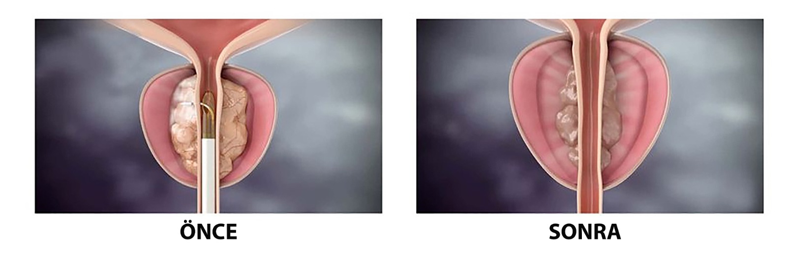 Prostat Büyümesi Tedavisinde Rezum Su Buharı Yöntemi