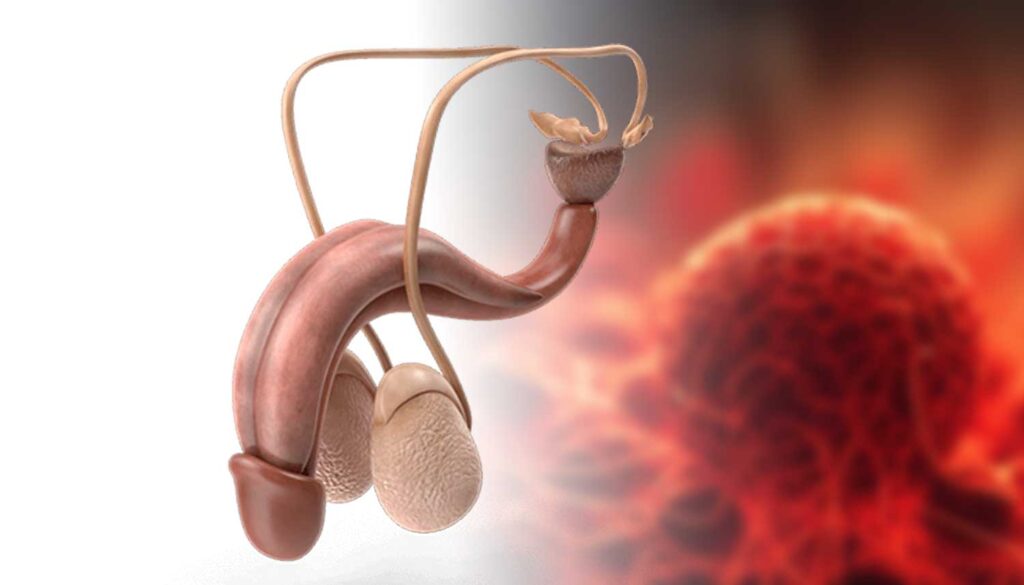 Prostat Kanseri Tedavisi - Robotik Cerrahi