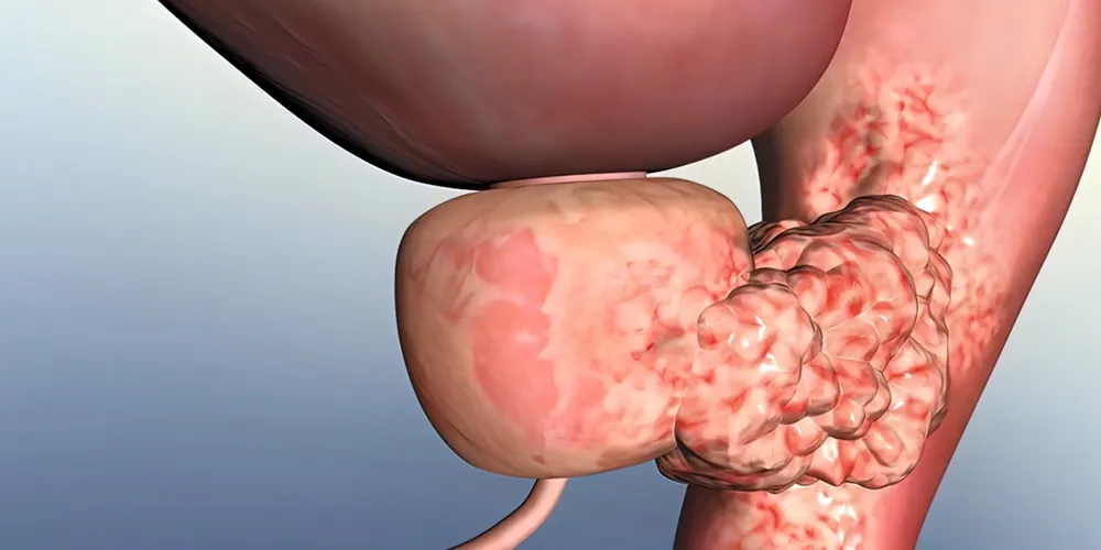 Prostat Kanseri Nedir ve Belirtileri Nelerdir?